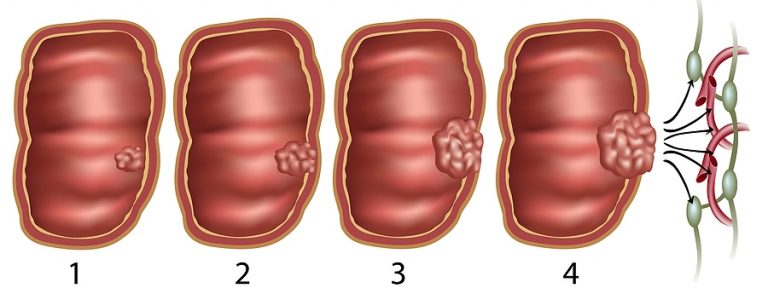 Vastagbélrák és végbélrák stádiumok